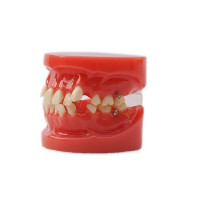 Opleiding Gebruik tandheelkundige tanden Onderwijsmodel Functioneel tandheelkundig orthodontisch model zonder beugel